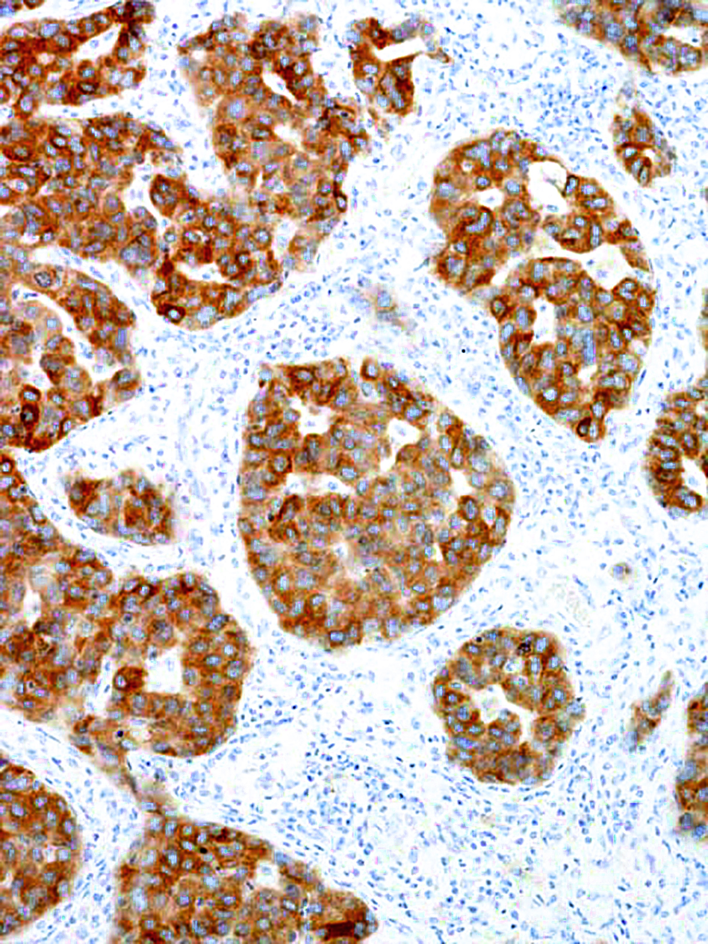 GeneAb™ ALK [IHC509] on Adenocarcinoma