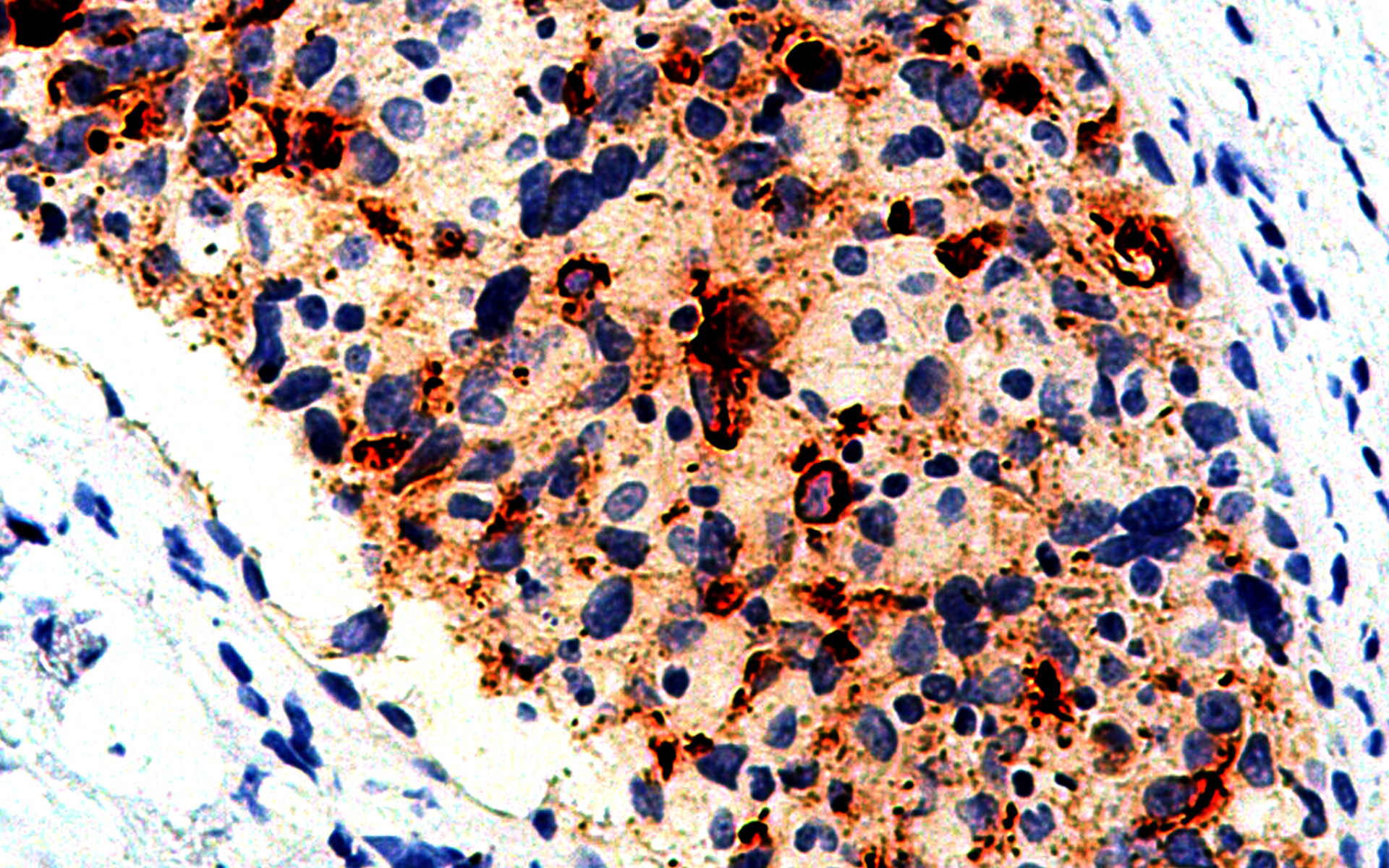 GeneAb™ BCA-225 [IHC225] on Breast Cancer