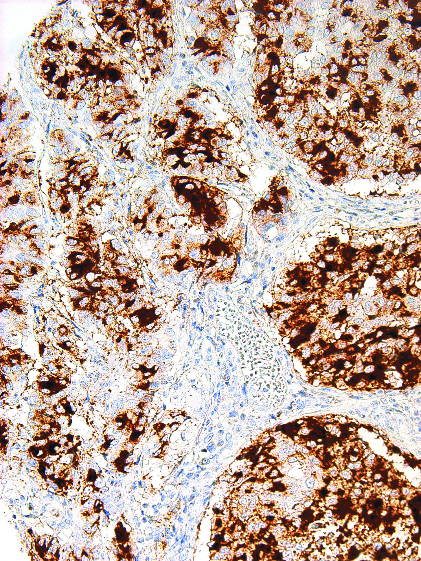 GeneAb™ BG8, LewisY [IHC517] on Thyroid Cancer