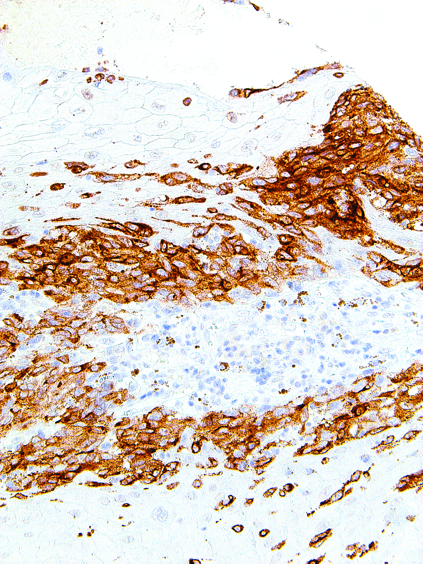 GeneAb™ MART-1 (Melan A) [IHC408] on Melanoma