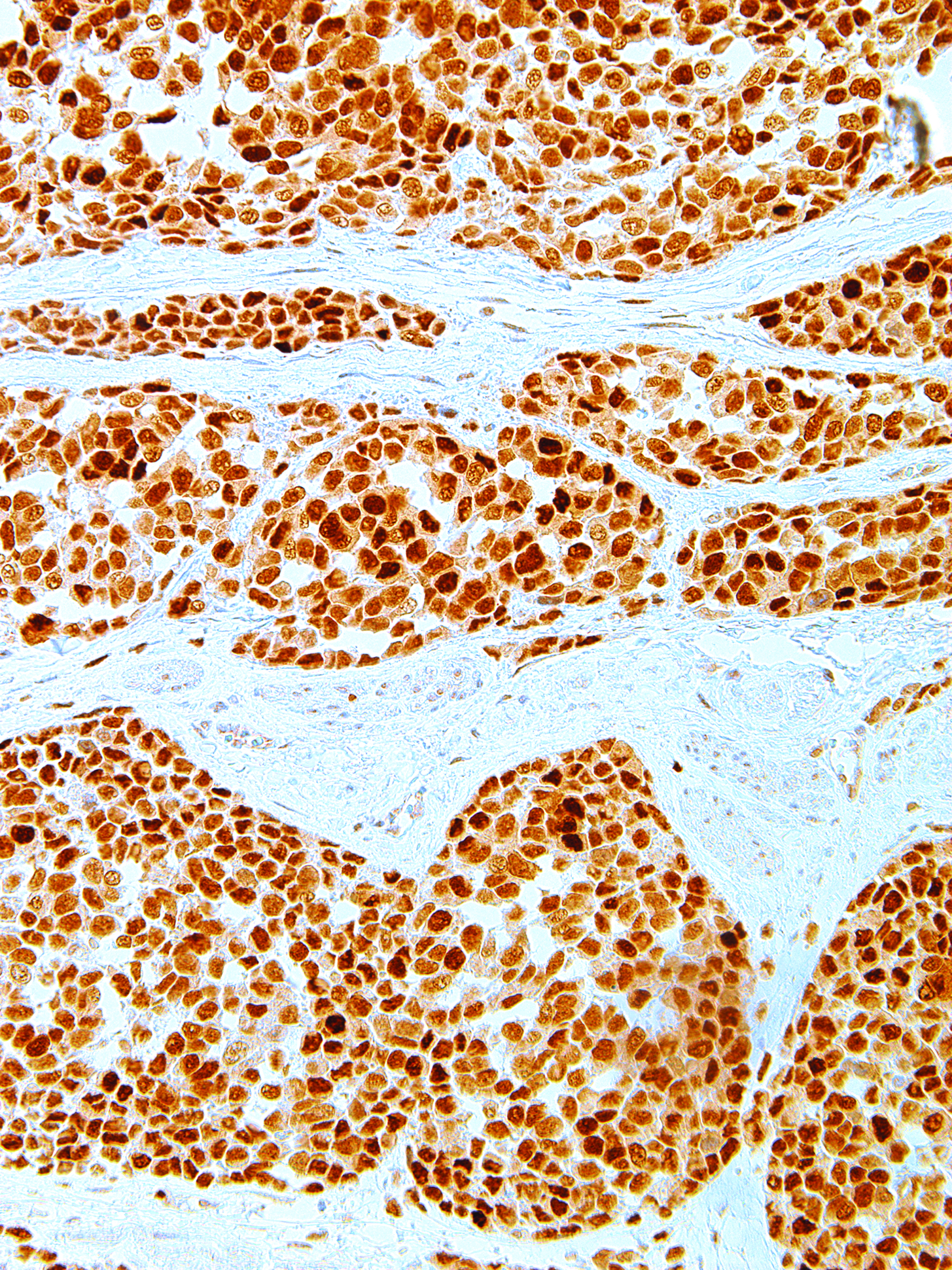 GeneAb™ MDM2 [IHC620] on Cervical Cancer