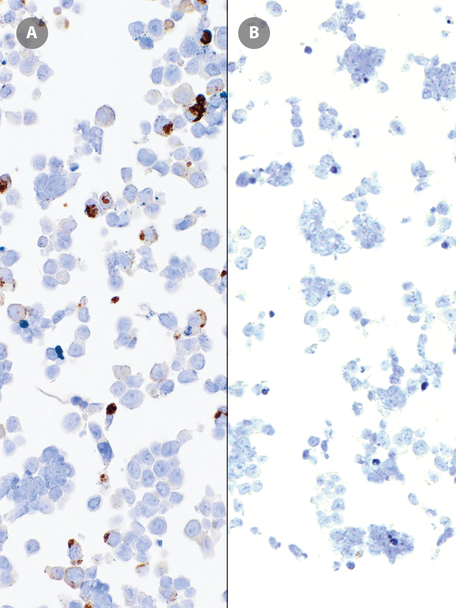 GeneAb™ NTRK [IHC707] on NTRK fusion cell line positive control and 293 negative cell line control.