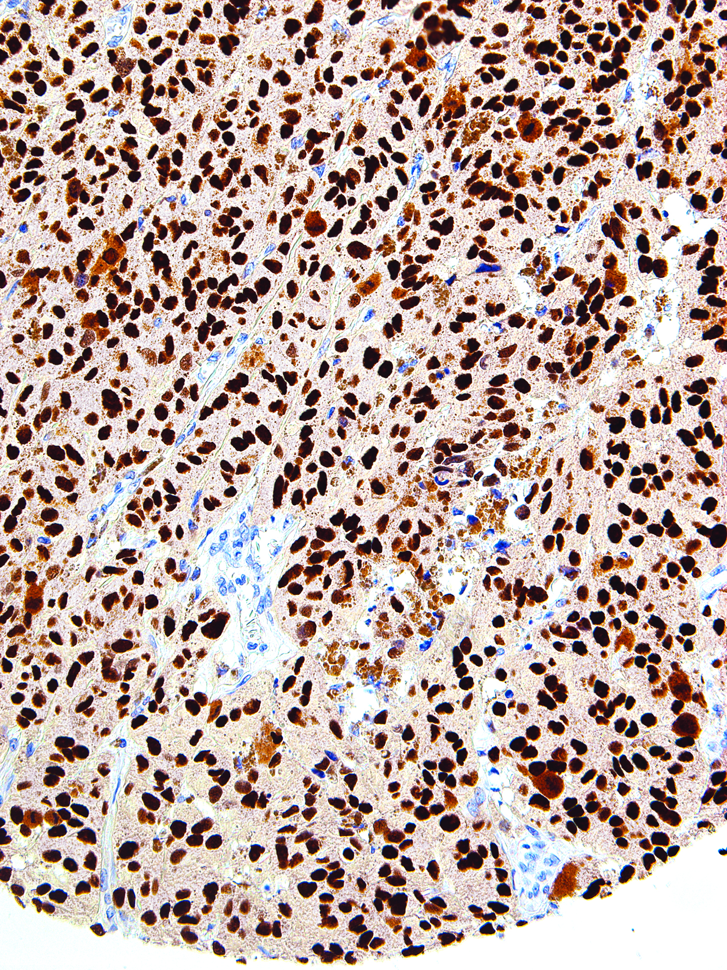 GeneAb™ SOX10 [IHC010] on Melanoma